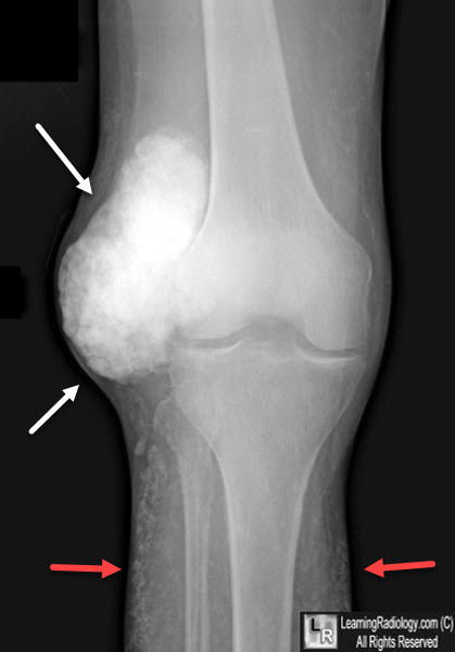 Calcinosis of Chronic Renal Failure.